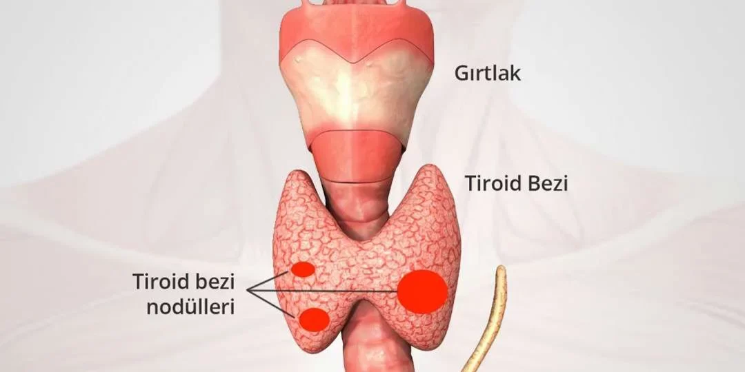 Tiroid ve Guatr Aynı Şey Mi